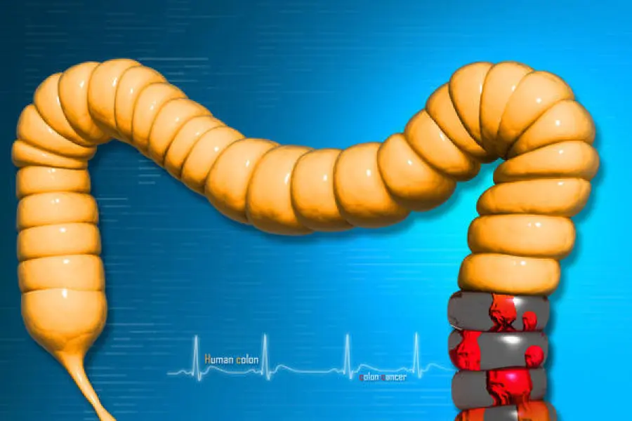 Il Megacolon tossico